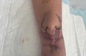 تحصل على أنف جديد زُرع في ذراعها 