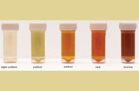 ما سبب تحول لون البول؟