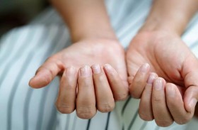 لون أظافرك قد يكشف ارتفاع نسبة الكوليسترول لديك!