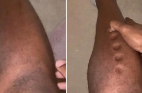 تحولت قدمه لـعجينة .. بعد إصابته بمرض خطير