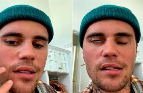 كل ما تريد معرفته عن مرض جاستن بيبر النادر