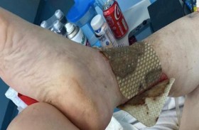 لدغة بعوضة كادت تبتر رجليها