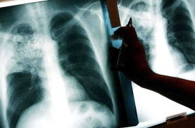 لقاح حديث قد يغيّر مستقبل مكافحة مرض السل