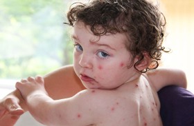 اكتشاف سبب وجود علاقة قوية بين جدري الماء وخطر الإصابة بالسكتة الدماغية!