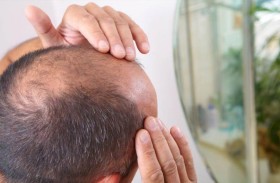 علاج عشبي شائع قد يوقف الصلع