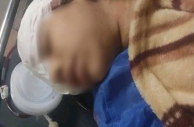 طفلة تفقد عينها جراء هجوم بالحجارة