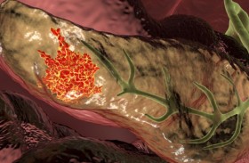 كيف يمكن الخلط بين سرطان البنكرياس وحالات أخرى؟!