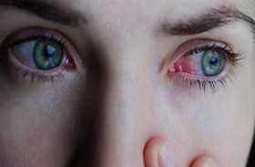 متى يجب استشارة الطبيب بسبب احمرار العين