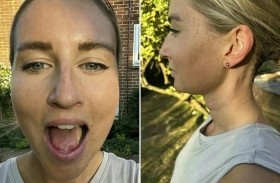 إعادة بناء لسان امرأة من ساقها 