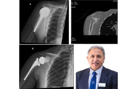 د.فيد بي جوسوامي  أجرى الجراحة باستخدام غرسة حقانية معززة على مريضة عمرها 57 عامًا تعاني من التهاب المفاصل الحاد