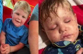 طفل يصطدم بـ«عش دبابير» ويُلدغ 150 مرة