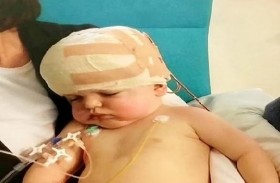 جراحون يعيدون تركيب جمجمة طفل