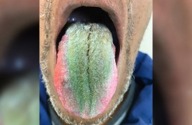لسبب غريب.. لسان رجل يتحول إلى الأخضر المشعر