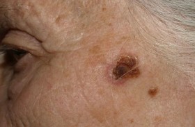 علماء يطورون نهجاً جديداً يمنع ارتداد المرض الفتاك