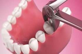 وفاة طفل بعد خلع أحد أسنانه