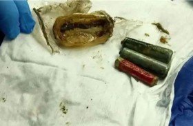 إخراج 3 بطاريات من معدة مريض