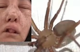 تشوه مرعب لامرأة لدغتها عناكب 