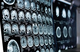 عارض ليلي مرتبط بالسكتة الدماغية