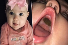 «دائرة مرعبة» في حلق طفلة