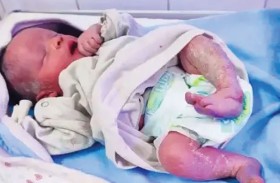 مصر.. ولادة نادرة بمتلازمة «الطفل الشمعي»