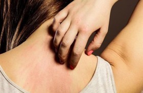 طبيبة تكشف أكثر أنواع الحساسية ندرة