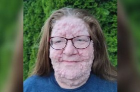 ورم ليفي يحول وجهها إلى فقاعات