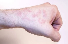 سرطان الجلد.. علامات على الجلد والأظافر تنذر بالخطر