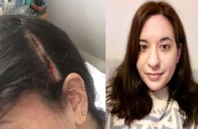 استئصال ورم من الدماغ دون تخدير