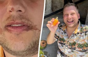 فاكهة مكسيكية تحرق وجه سائح 