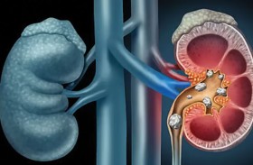 باحثون أمريكيون يبتكرون علاجا جذريا لحصوات الكلى