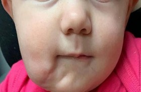 طفلة تخضع لجراحة رائدة بعدما ولدت بفم إضافي