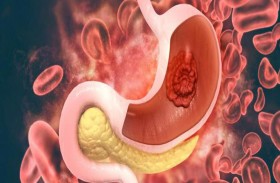 أسباب وأعراض سرطان المعدة