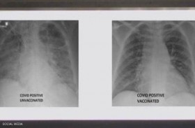ملقح وغير ملقح...صور الأشعة تكشف أثر كورونا على الرئتين