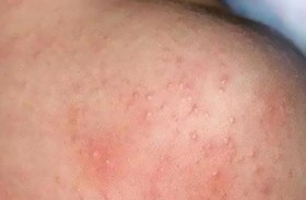 شريط لاصق يتنبأ بالأكزيما 