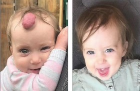 رضيعة تنجو بإزالة ورم كبير من جبينها