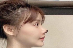 تصاب بتعفن في أنفها بعد عملية تجميل فاشلة