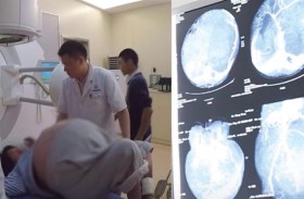 تعيش مع ورم وزنه 35 كلغ في رحمها