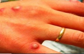 عشرات الإصابات بـ جدري القردة في إسبانيا والبرتغال