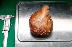 استئصال أكبر وأثقل حصوة كلوية بالعالم