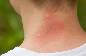 لدغــات بعــوض مكثفــة..  والغــرض نبيــل