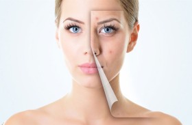 للحصول على بشرة خالية من حب الشباب.. تجنب هذه المشروبات