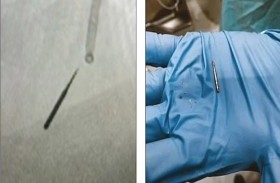 إخراج مثقب أسنان من رئتي مريض 