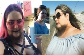 حالة نادرة تسبب لها نمو لحية طويلة
