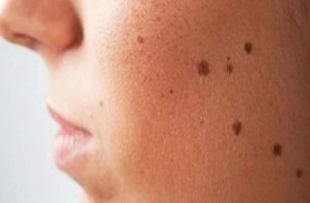 أخصائي أمراض جلدية: بعض الشامات يمكن أن تكون قاتلة