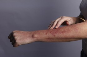 جلده «يحترق» إذا أكل  النوع الخطأ من الطعام