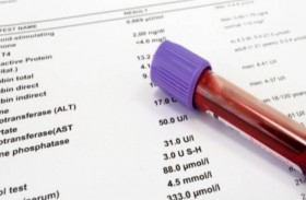 خبراء: لا حاجة للصيام في بعض تحاليل الدم