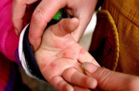 إنفلونزا الطماطم.. عدوى تنتشر بين الأطفال