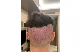 عيادة تركية تبتز بريطانياً بعد عملية زرع شعر فاشلة