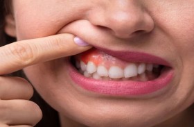 نزيف اللثة ينذر بالتهاب دواعم السن
