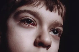 طفل يبكي دما يثير ذهول الأطباء